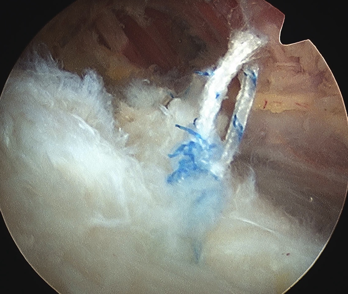 Arthroscopic Supraspinatous Repair